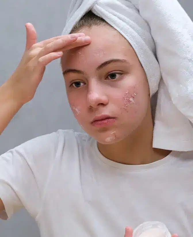 Acne Treatment Mankato MN
